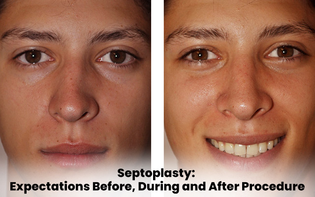 Septoplasty: Expectations Before, During and After Procedure