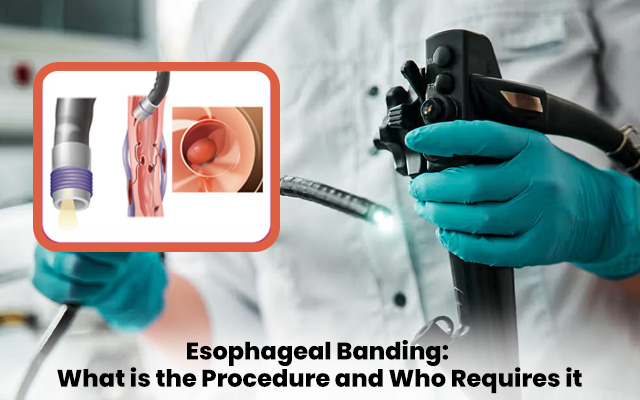 Esophageal Banding: What is the Procedure and Who Requires it