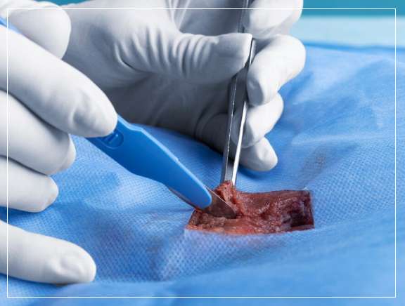 The Biopsy Procedure