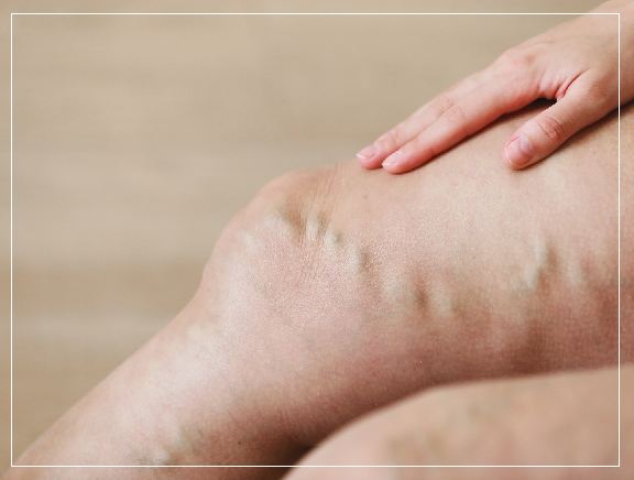 Why Choose Vitadell Healthcare for Varicose Veins? Why Choose Vitadell Healthcare for Varicose Veins?