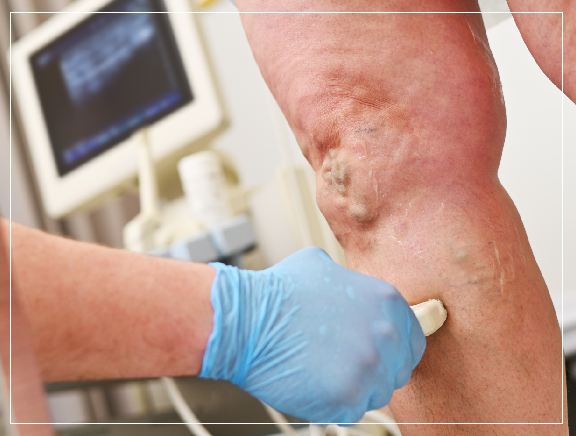 Varicose Veins Overview Varicose Veins Overview
