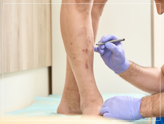When to Visit a Specialist for Varicose Veins? When to Visit a Specialist for Varicose Veins?